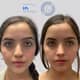Slider image (10) Dr. Guillermo Guerra Gil de Leyva - Rhinoplasty Specialist